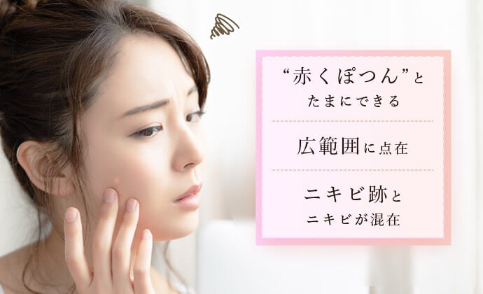 ニキビの出来かたは様々