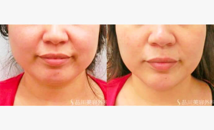 脂肪溶解注射の症例