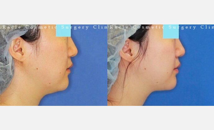 脂肪溶解注射の症例