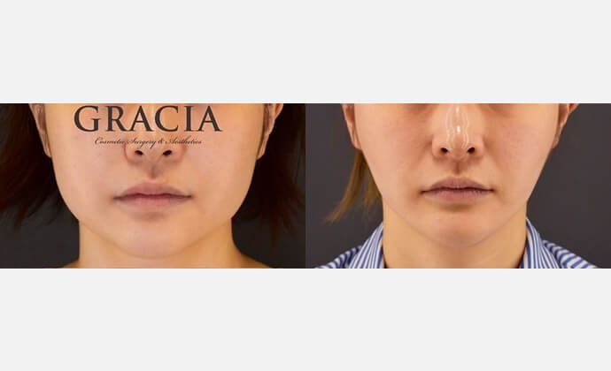 脂肪吸引の症例