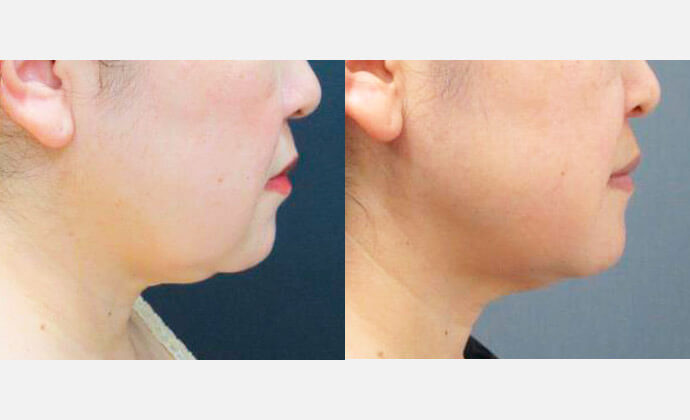 脂肪冷却の症例