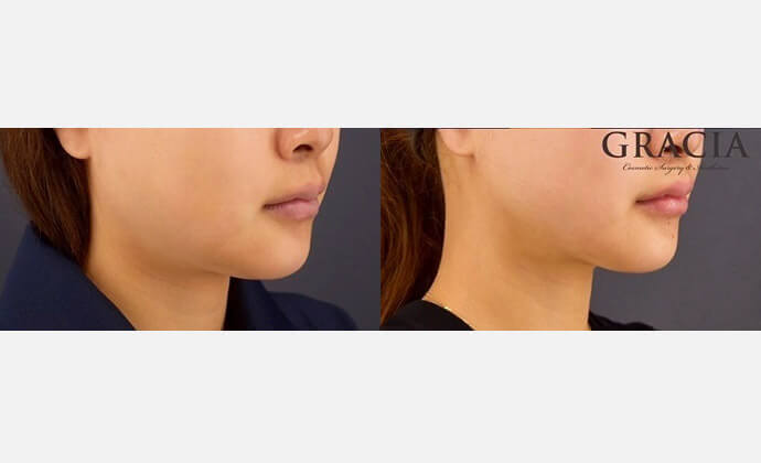 脂肪吸引の症例