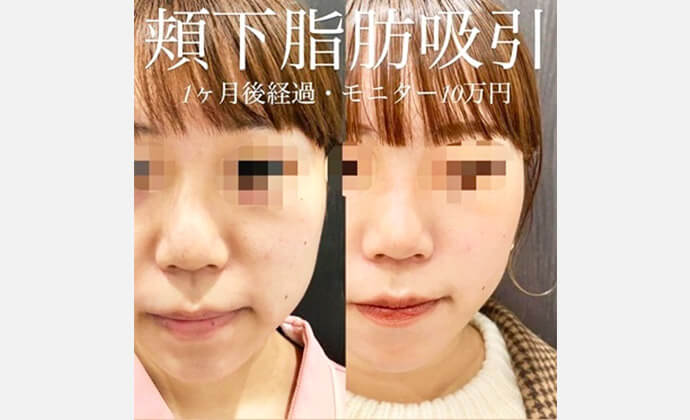 脂肪吸引の症例