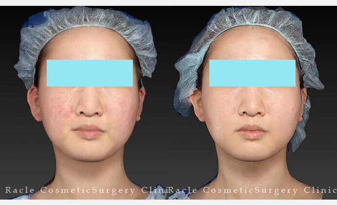 リニアHIFUの症例