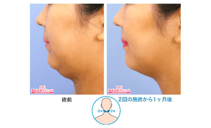 脂肪冷却の症例