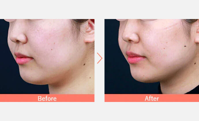 リニアHIFUの症例