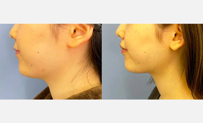 脂肪吸引注射の症例